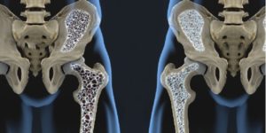 osteoporosi